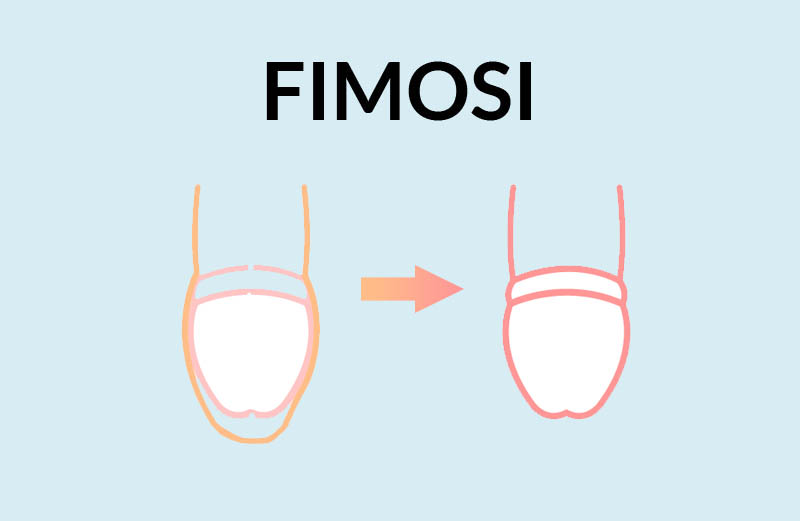 fimosi intervento, fimosi operazione