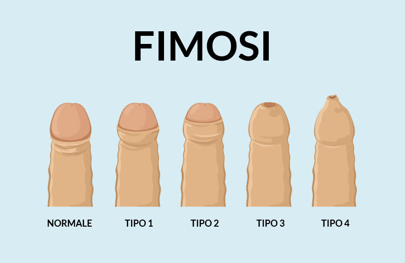 Fimosi, fimosi intervento, fimosi operazione